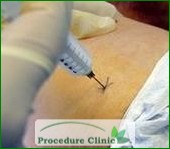 Hip injection for trochanteric Bursitis